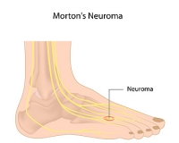 Nerve Pain Between the Toes