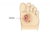 Foot Ulcers Can Be a Serious Condition
