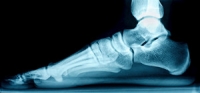 Certain Hereditary Conditions May Cause Flat Feet