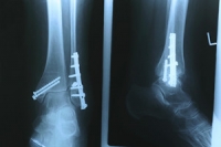Possible Treatment of a Broken Foot